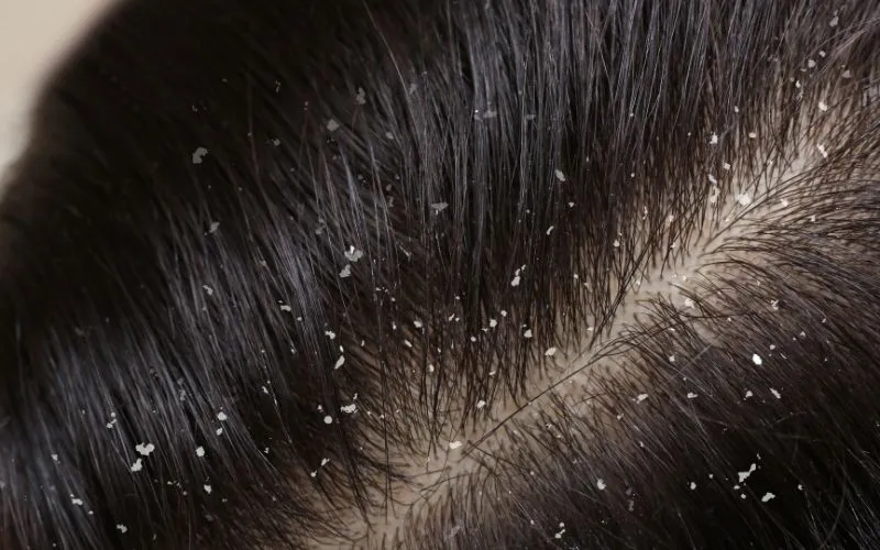 Dandruff Shampoo for Color-Treated Hair